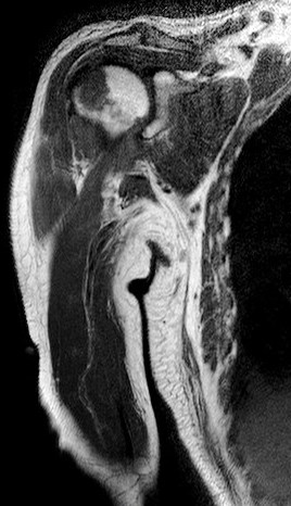 Figure 4 for case amyloid arthropathy ( RID5188 )